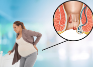 Bị bệnh trĩ có mang thai được không