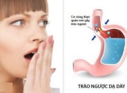 Trào ngược dạ dày gây ho đờm kéo dài