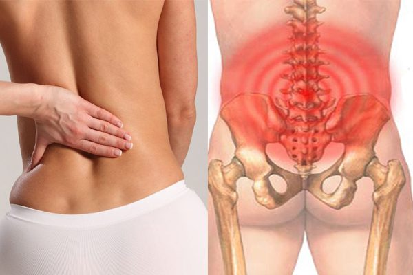 Đau lưng dưới gần mông là vị trí có rất nhiều người bị