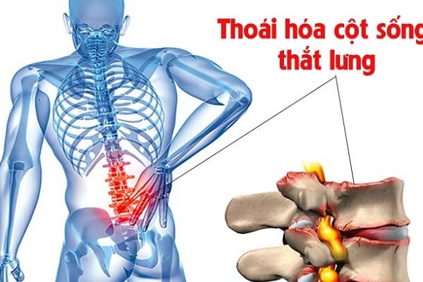 Hình ảnh thoái hóa cột sống thắt lưng (Ảnh minh họa)