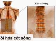 Vôi hóa cột sống lưng - đốt sống cổ