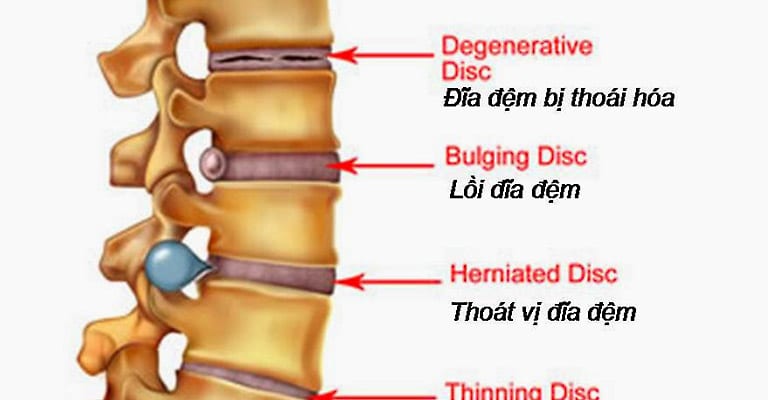 Hiện tượng phồng lồi đĩa đệm trước khi chuyển sang giai đoạn thoát vị