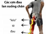 Đau lưng lan xuống mông, chân là bệnh gì