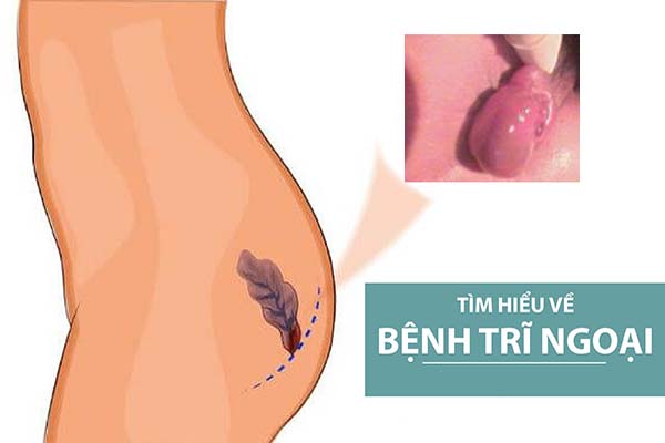 Trĩ ngoại là gì Nguyên nhân triệu chứng bệnh