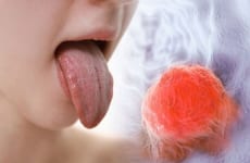 Lưỡi trắng đau họng là dấu hiệu bệnh gì?