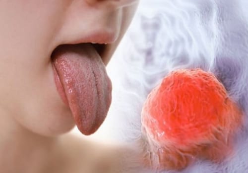 Lưỡi trắng đau họng là dấu hiệu bệnh gì?