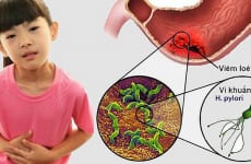 Nguyên nhân dẫn tới viêm loét dạ dày ở trẻ em