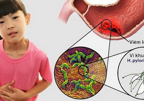 Nguyên nhân dẫn tới viêm loét dạ dày ở trẻ em