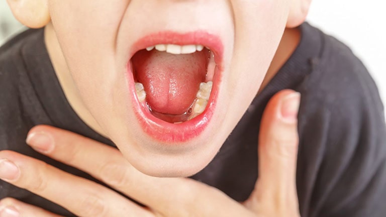 Rát lưỡi đau họng là dấu hiệu quả bệnh gì?