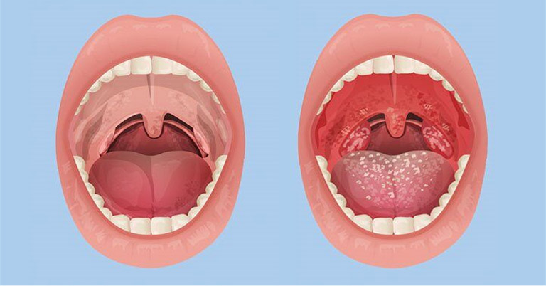 Tìm hiểu bệnh viêm họng hạt ở lưỡi