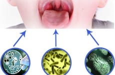 Viêm họng nhiễm khuẩn là gì? Nguyên nhân do đâu?