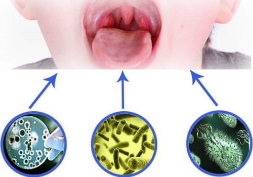 Viêm họng nhiễm khuẩn là gì? Nguyên nhân do đâu?