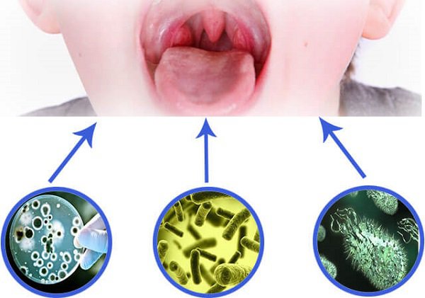 Viêm họng nhiễm khuẩn là gì? Nguyên nhân, biểu hiện và cách điều trị