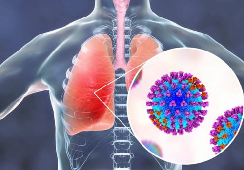 Tìm hiểu về bệnh lý viêm phổi