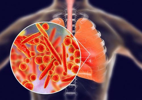 Bệnh viêm phổi có lây không?