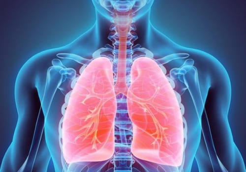 Viêm phổi mắc phải ở cộng đồng là gì?