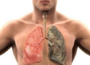 Tìm hiểu viêm phổi hít là gì?