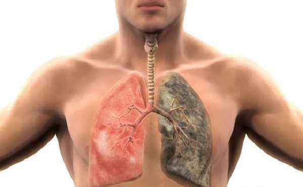 Tìm hiểu viêm phổi hít là gì?