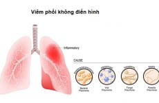 Tìm hiểu về bệnh viêm phổi không điển hình