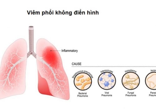 Tìm hiểu về bệnh viêm phổi không điển hình